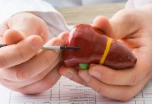 Grade 2 fatty liver 3 e1653307059783 1 220x150 - کبد چرب گرید ۲: علائم، علت، تشخیص و درمان کبد چرب گرید ۲