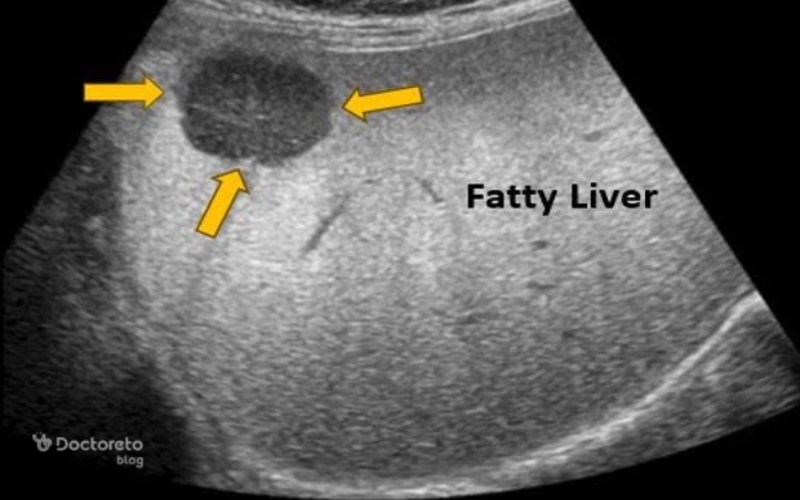 کبد چرب گرید ۲: علائم، علت، تشخیص و درمان کبد چرب گرید ۲ fatty liver grade 2 image - کبد چرب گرید ۲: علائم، علت، تشخیص و درمان کبد چرب گرید ۲